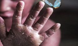 حمایت ویژه از بیماران پروانه‌ای در استان همدان