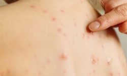 هیچ بیمار مبتلا به سرخک در همدان شناسایی نشده است