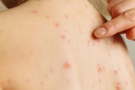 هیچ بیمار مبتلا به سرخک در همدان شناسایی نشده است