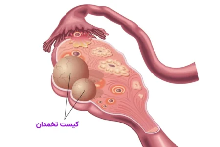 کیست تخمدان؛ مشکل شایع اما اغلب بی‌خطر در زنان سن باروری