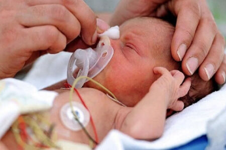 قریب به ۱۰ درصد از نوزادان همدان نارس هستند