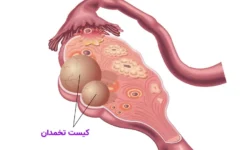 کیست تخمدان؛ مشکل شایع اما اغلب بی‌خطر در زنان سن باروری